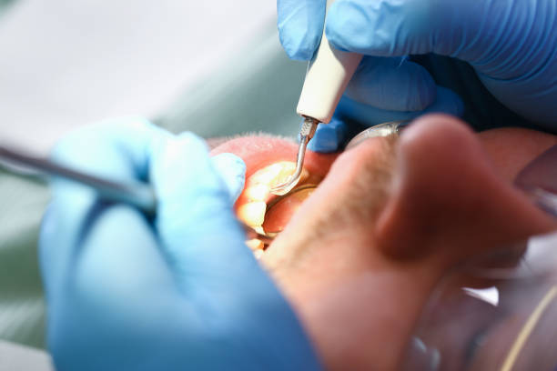 Best Urgent Care for Lost Fillings or Crowns in Anaheim, CA